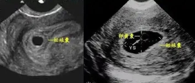 为什么胎停育会毫无征兆？没流血、没腹痛，宝宝怎么就没了？​孕早期激素紊乱如何导致胎停育？