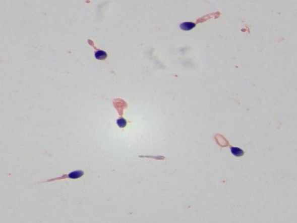 什么样的精子才算健康？精子形态异常会影响怀孕吗？备孕男性必看！