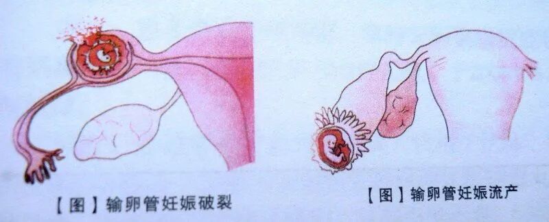 试管婴儿移植后为什么要补黄体酮?试管婴儿黄体酮怎么用?黄体酮对胚胎着床有多重要? 试管婴儿移植后为什么要补黄体酮?试管婴儿黄体酮怎么用?黄体酮对胚胎着床有多重要?