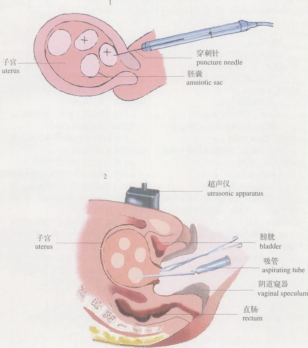 什么是减胎手术? 试管婴儿多胎妊娠必须减胎吗？试管婴儿怀双胎后减胎手术安全吗？