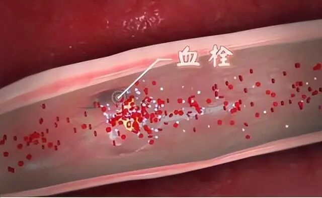 慢性炎症会影响生育力吗?卵巢内暗藏“生育杀手”:慢性炎症与不孕的真相! 慢性炎症会影响生育力吗?卵巢内暗藏“生育杀手”:慢性炎症与不孕的真相!