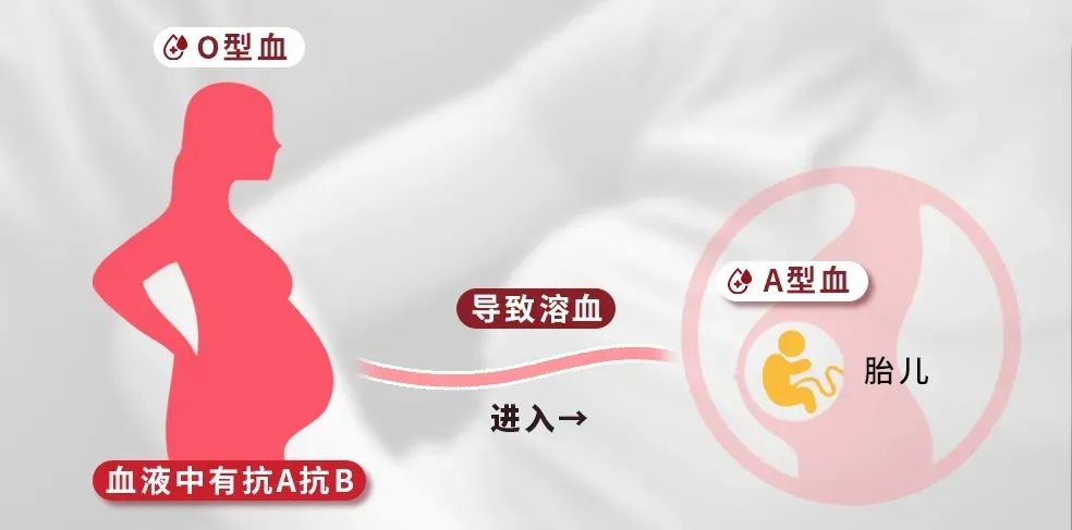 血型不合真的会导致新生儿溶血吗？​夫妻血型组合如何影响胎儿健康？​