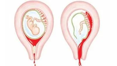 试管婴儿反复胎停？过度免疫用药可能适得其反！这3个治疗盲区你可能忽略了！