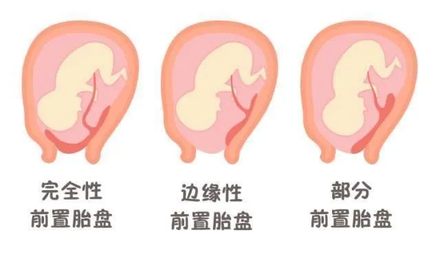 孕期胎动异常怎么办？胎儿缺氧的6大危险信号，孕妈妈要知道！！