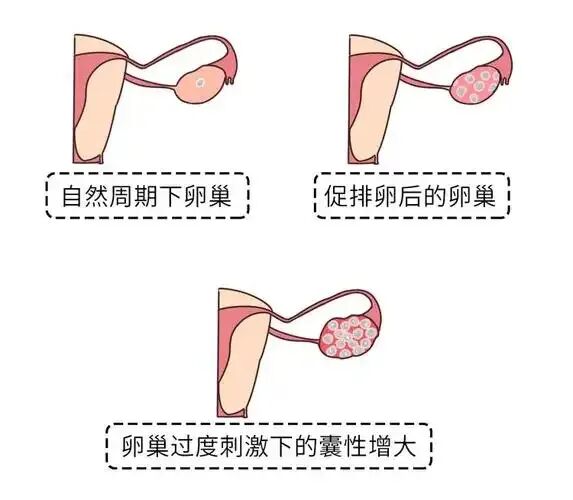 试管婴儿移植后为什么要补黄体酮?试管婴儿黄体酮怎么用?黄体酮对胚胎着床有多重要? 试管婴儿移植后为什么要补黄体酮?试管婴儿黄体酮怎么用?黄体酮对胚胎着床有多重要?