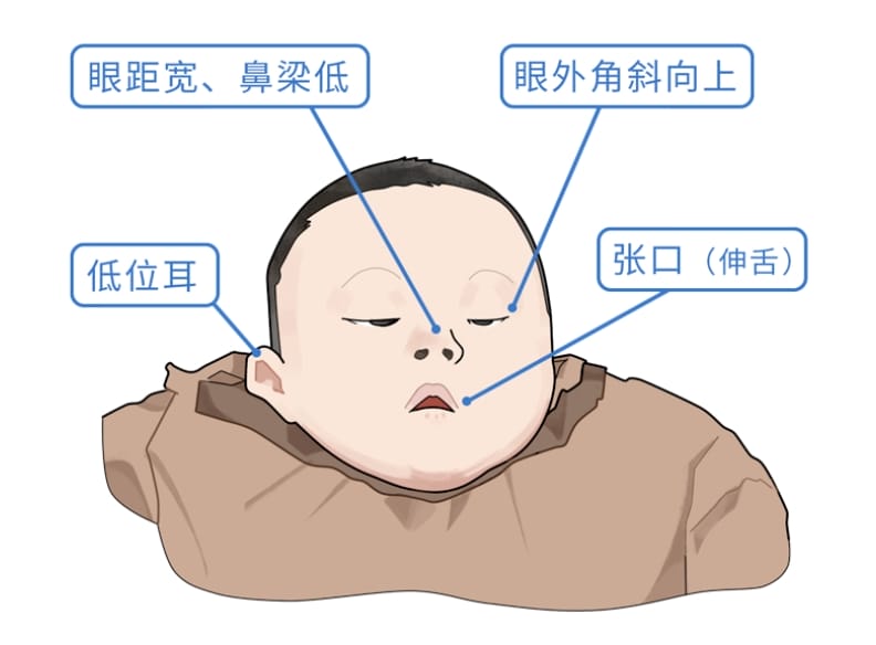 什么是唐氏综合症？为什么要重视唐氏综合征？世界唐氏综合征日 | 知“唐”控“唐”，孕育健康宝宝！