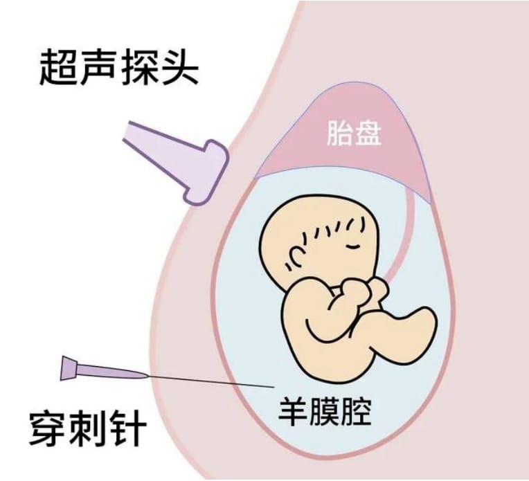 什么是唐氏综合症？为什么要重视唐氏综合征？世界唐氏综合征日 | 知“唐”控“唐”，孕育健康宝宝！