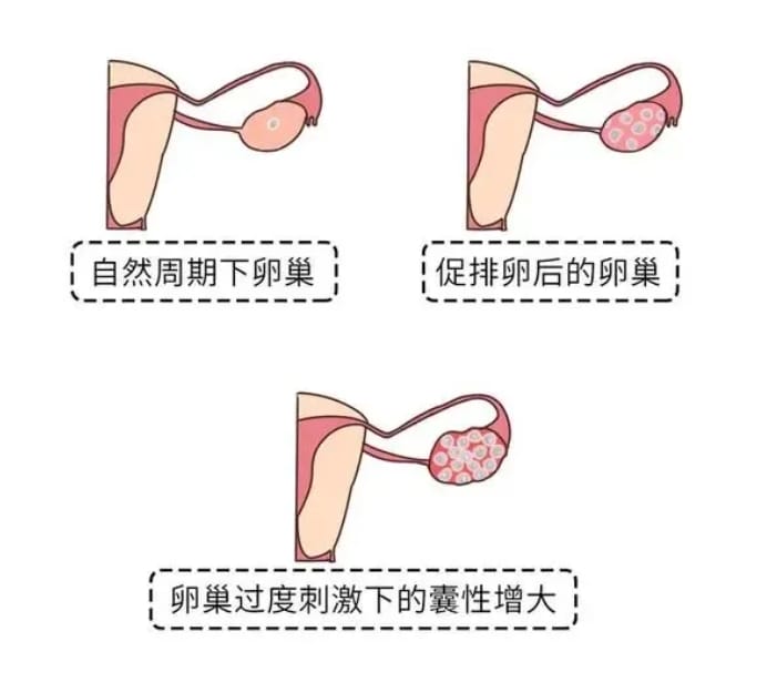什么是试管婴儿胚胎冷冻？试管婴儿冷冻胚胎的意义及应用有哪些？