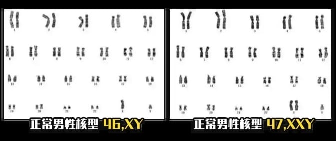 克氏综合征是什么？克氏综合征的临床表现有哪些？克氏综合征患者可通过试管婴儿技术生育宝宝