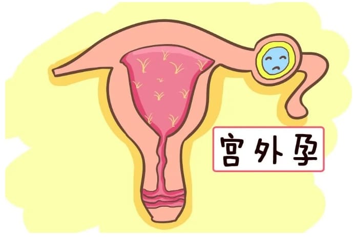 宫外孕是怎么回事？做试管婴儿会不会发生宫外孕？怎样预防宫外孕？