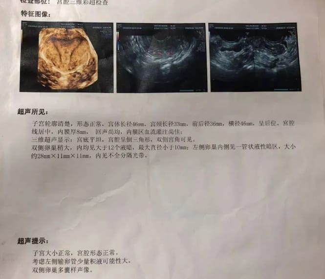 输卵管积水的检查及治疗方法是什么？输卵管积水引起的不孕要直接做试管婴儿吗？