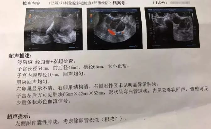 输卵管积水的检查及治疗方法是什么？输卵管积水引起的不孕要直接做试管婴儿吗？