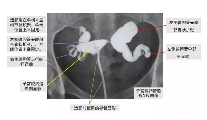 输卵管积水的检查及治疗方法是什么？输卵管积水引起的不孕要直接做试管婴儿吗？
