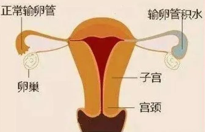 输卵管积水的检查及治疗方法是什么？输卵管积水引起的不孕要直接做试管婴儿吗？