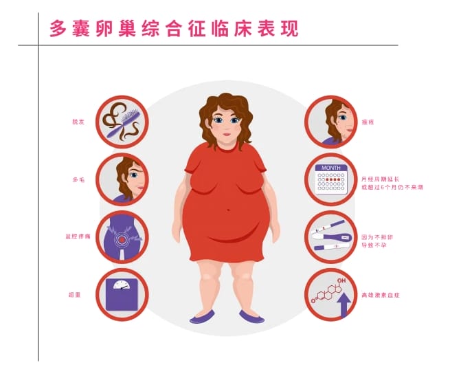 多囊卵巢综合征怎么治疗才能更快好孕？多囊卵巢综合征对女性生育和生活质量有何影响？
