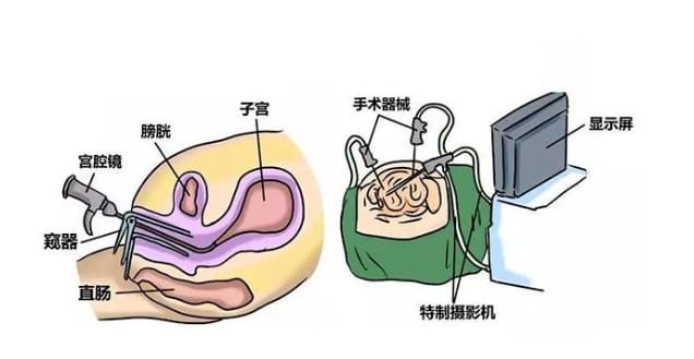 多囊卵巢综合征怎么治疗才能更快好孕？多囊卵巢综合征对女性生育和生活质量有何影响？