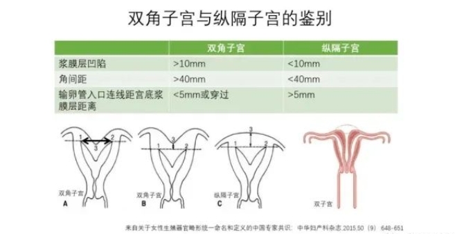 什么是子宫畸形？子宫畸形怎么诊断？子宫畸形对试管婴儿成功率有何影响？