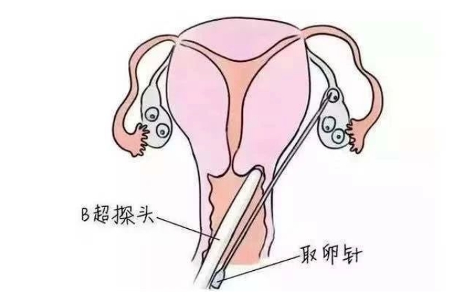 试管婴儿反复促排是否真的会对卵子造成影响？试管婴儿反复促排对后代糖代谢功能的影响有哪些？