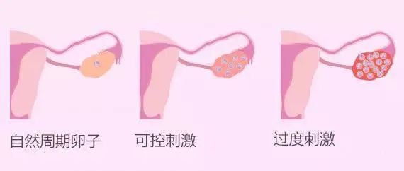 试管婴儿促排卵药物真的会导致女性发胖吗？促排卵引起的水肿和肥胖有什么区别？