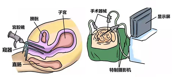 哪些宫腔问题会影响胚胎着床?如何通过宫腔镜检查提高成功率? 哪些宫腔问题会影响胚胎着床?如何通过宫腔镜检查提高成功率?